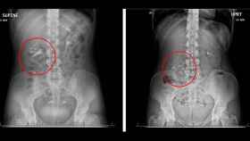 Entre la postura sentada y de pie, el riñón de la mujer se movió 5 cms.
