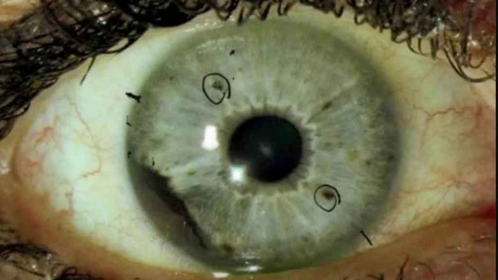 Melanoma ocular, el raro cáncer de ojo que está arrasando en EEUU