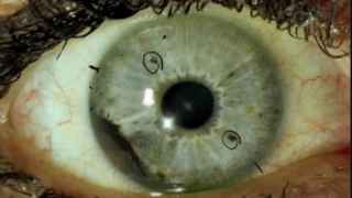La manchita en el ojo que 'anuncia' un cáncer: estos son los síntomas del melanoma ocular