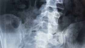 Una radiografía de un adolescente con escoliosis.