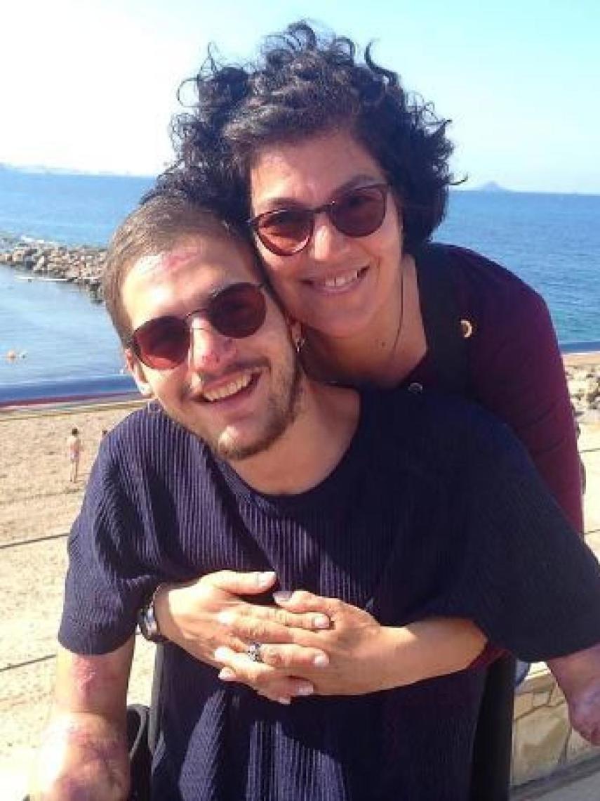 Davide una vez recibió el alta hospitalaria. Le raparon el pelo en Urgencias y se puede observar uno de sus muñones.