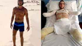 Davide Morana antes y después de la meningitis.