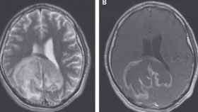 Una radiografía del cerebro en la que se ven parásitos.