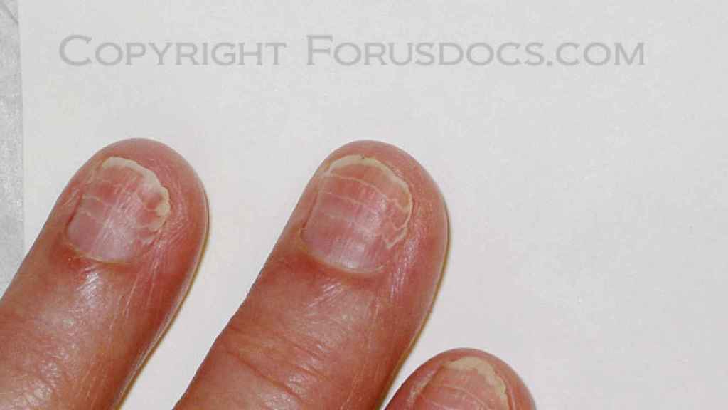 Paroniquia Infección por morderse las uñas y todo lo que debes saber  GQ