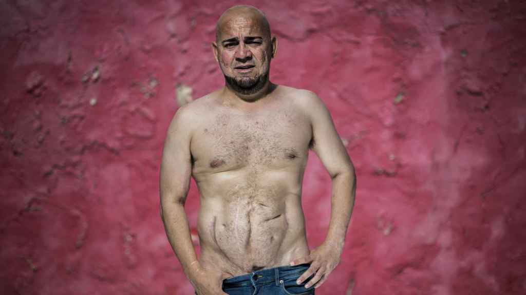 Luis Rodríguez Guerrero mostrando las cicatrices de los cinco trasplantes de riñón que ha superado durante su vida.