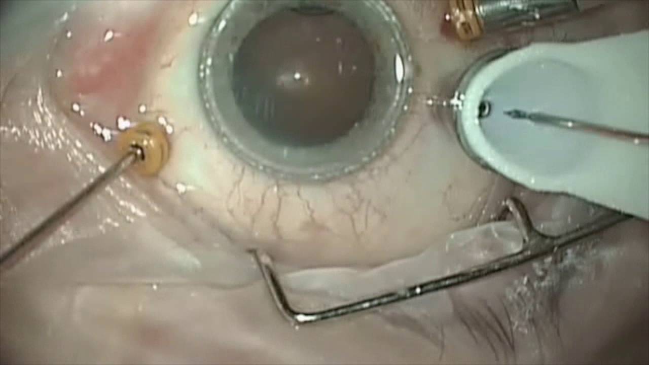PRECEYES robot cirugia ocular operacion ojo cirujano ojo