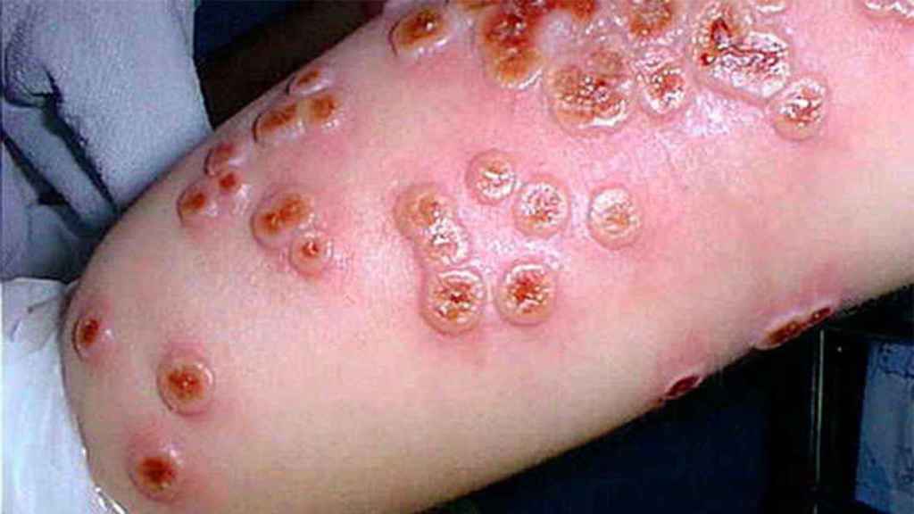 Las lesiones en forma de pústulas en la piel que provoca la viruela bovina.