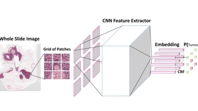 deteccion de cancer inteligencia artificial cancer tumores baidu