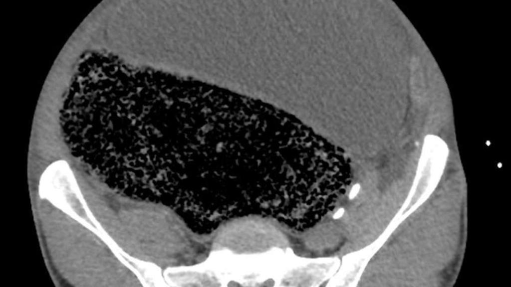 La masa fecal vista en el corte longitudinal, y la presión sobre las arterias.