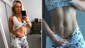 La influencer australiana Soph Allen visibiliza la endometriosis con la cicatriz de su abdomen.
