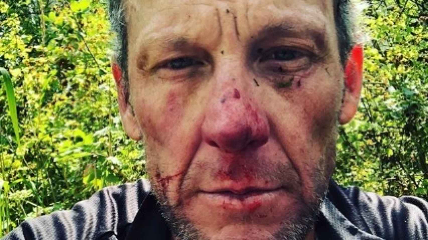 Lance Armstrong tras un accidente. Foto: Instagram (@lancearmstrong)