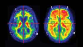 Imagen de un PET cerebral. A la izquierda, las placas de beta-amiloide en un paciente sano y a la derecha en un paciente con alzheimer.