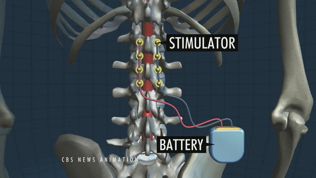 implantes electricos chips medula espinal paraplejicos