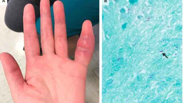 El dedo meñique hinchado de un paciente que desarrolló tuberculosis.