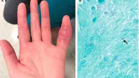 El dedo meñique hinchado de un paciente que desarrolló tuberculosis.