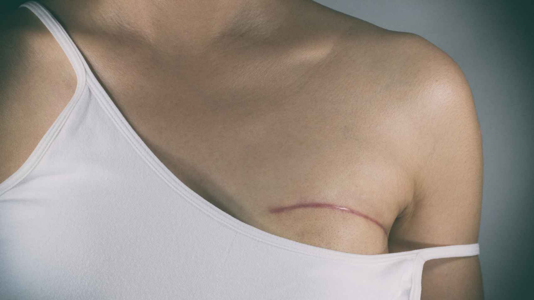Cicatriz de una mastectomía.