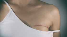 Cicatriz de una mastectomía.