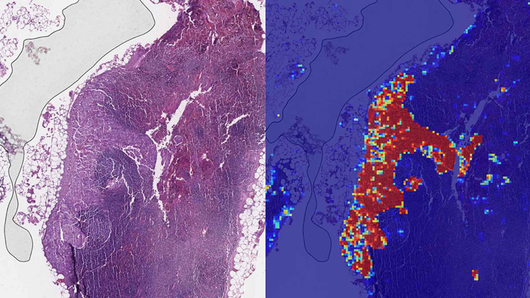 ganglios linfaticos regiones tumorales inteligencia artificial google cancer tumores