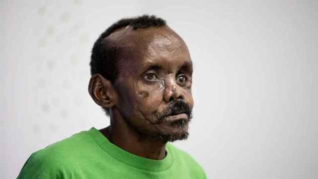 El pastor keniata Lonunuku, de 58 años, tras la reconstrucción parcial del rostro y la mano izquierda