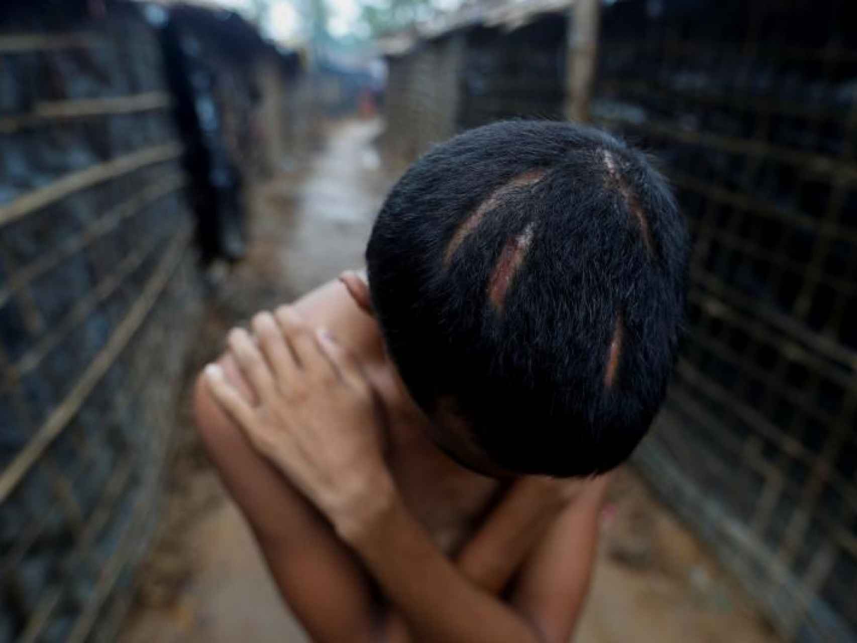 Un refugiado muestra cicatrices en su cabeza