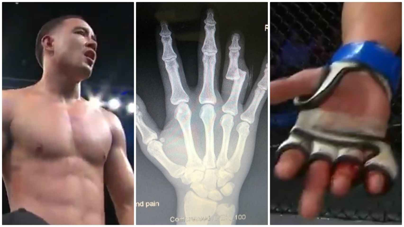 Un luchador de MMA gana su combate con la mano rota y un hueso al aire