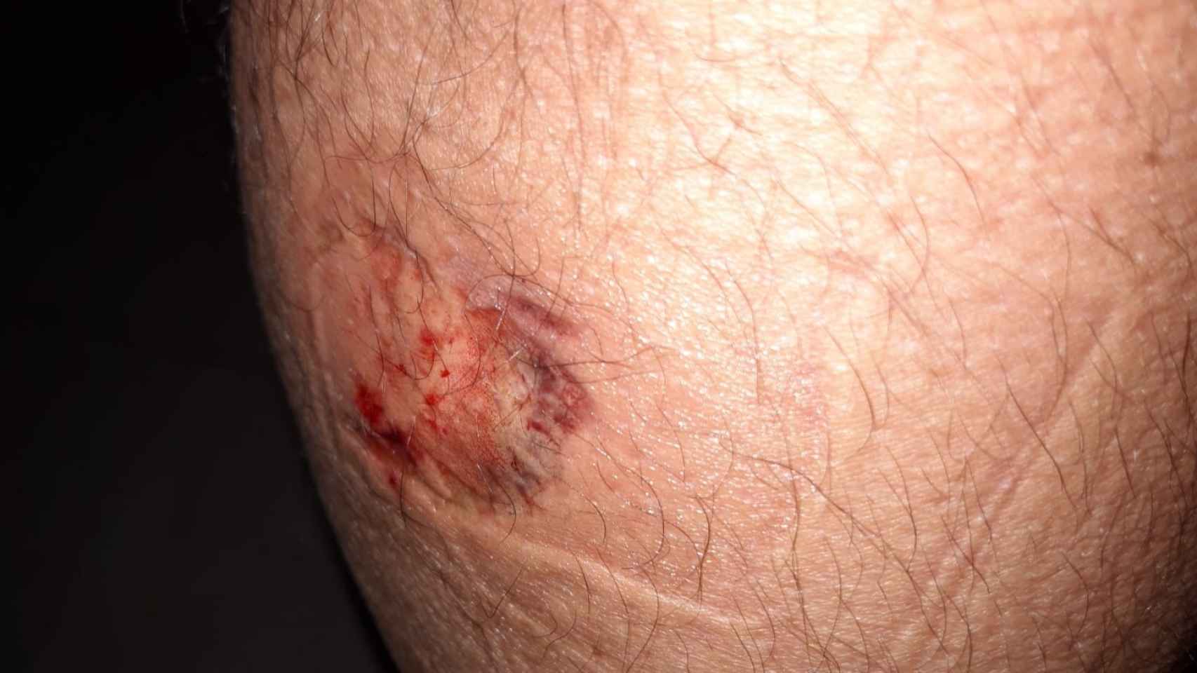 La herida producida en uno de los funcionarios tras el mordisco del preso.