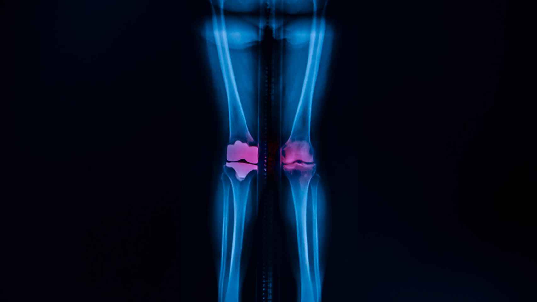 Este nuevo material mejorará las prótesis de rodilla y cadera.