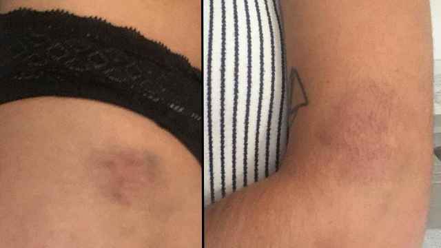 Heridas provocadas por atropello de un patinete eléctrico