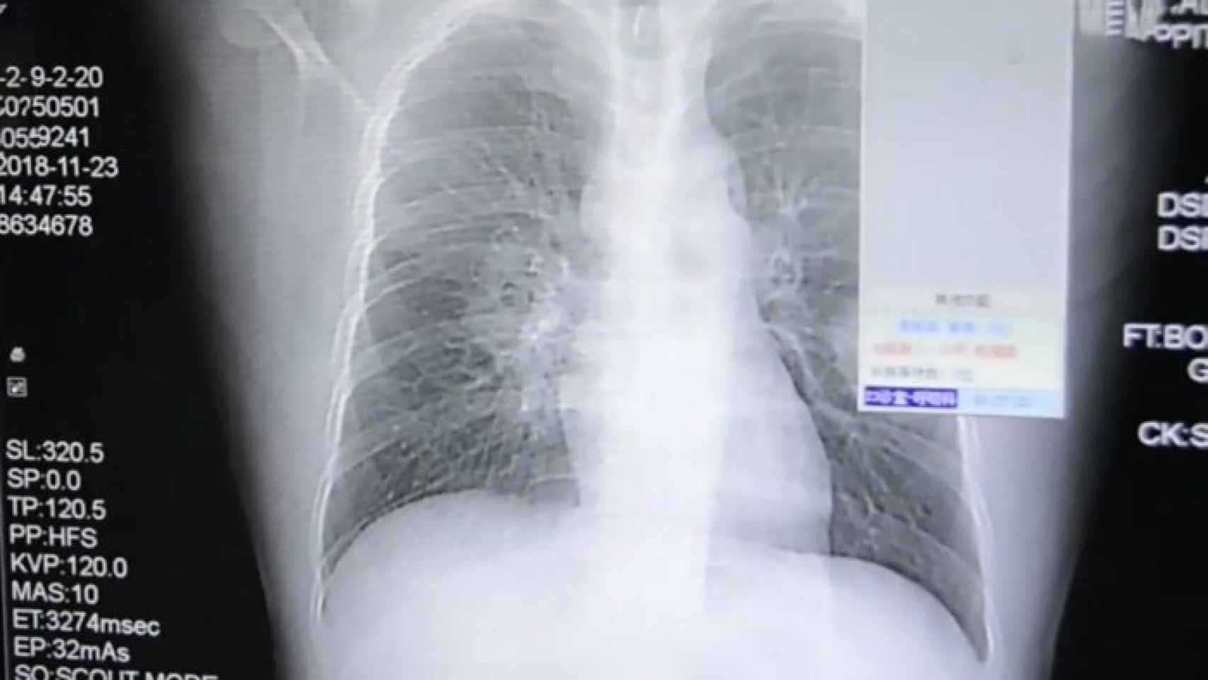 Radiografía del paciente.