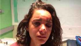 Andrea Sicignano, estudiante estadounidense residente en Madrid, tras el ataque y violación.