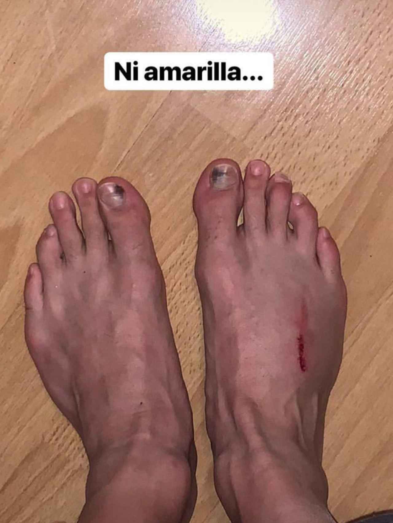 Reguilón muestra sus heridas en Instagram
