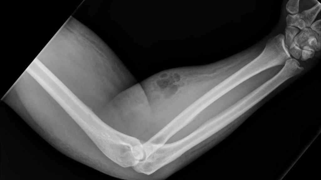 La radiografía del bulto en el brazo del paciente. Dunne et al (Irish Medical Journal)