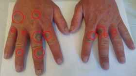 Las marcas de la fitodermatitis en las manos del paciente.