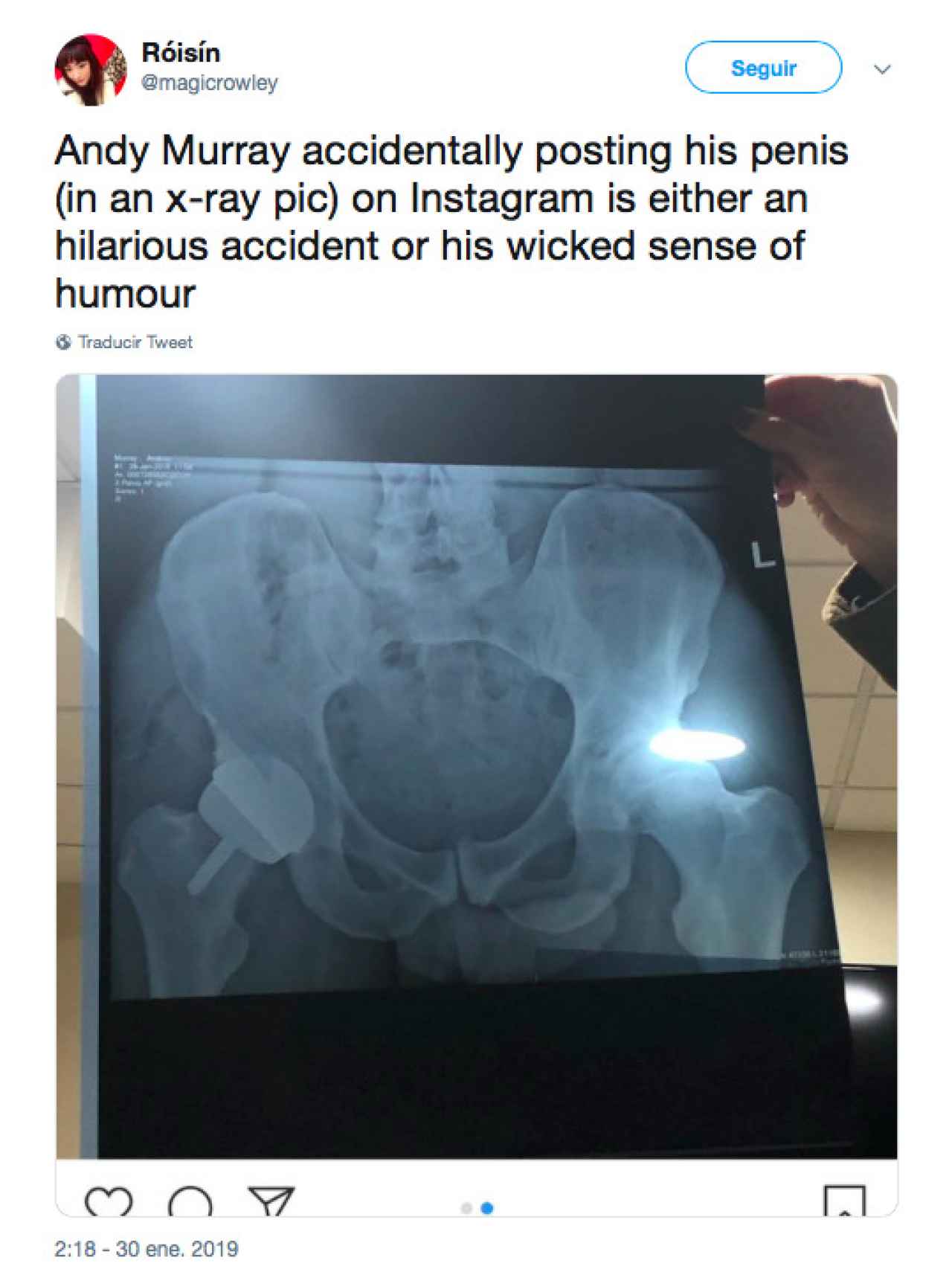 La radiografía viral de Andy Murray