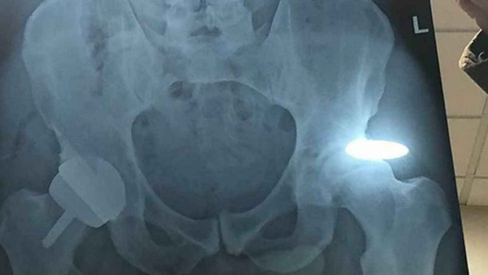 La radiografía de la cadera de Andy Murray