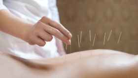 Una profesional aplica una sesión de acupuntura a una paciente.