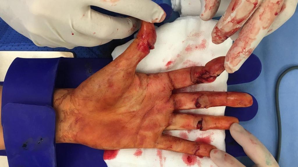 La mano de Kvitova tras ser acuchillada