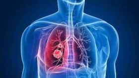 Representación de un cáncer de pulmón