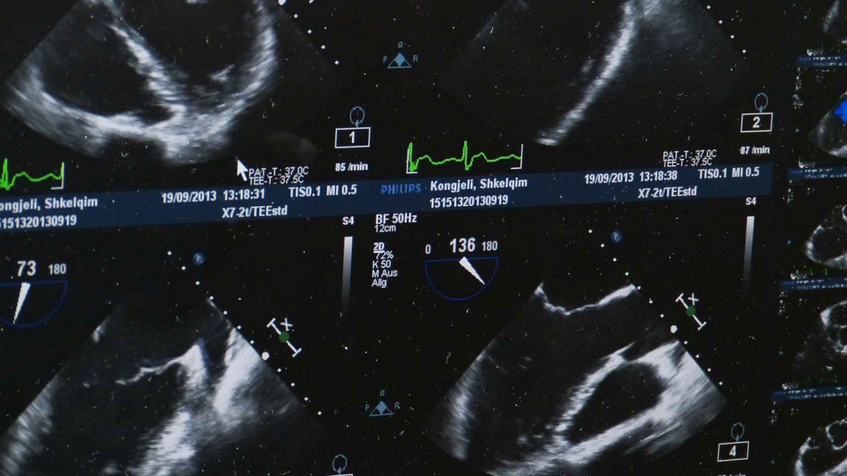 ultrasonido ecografia feto