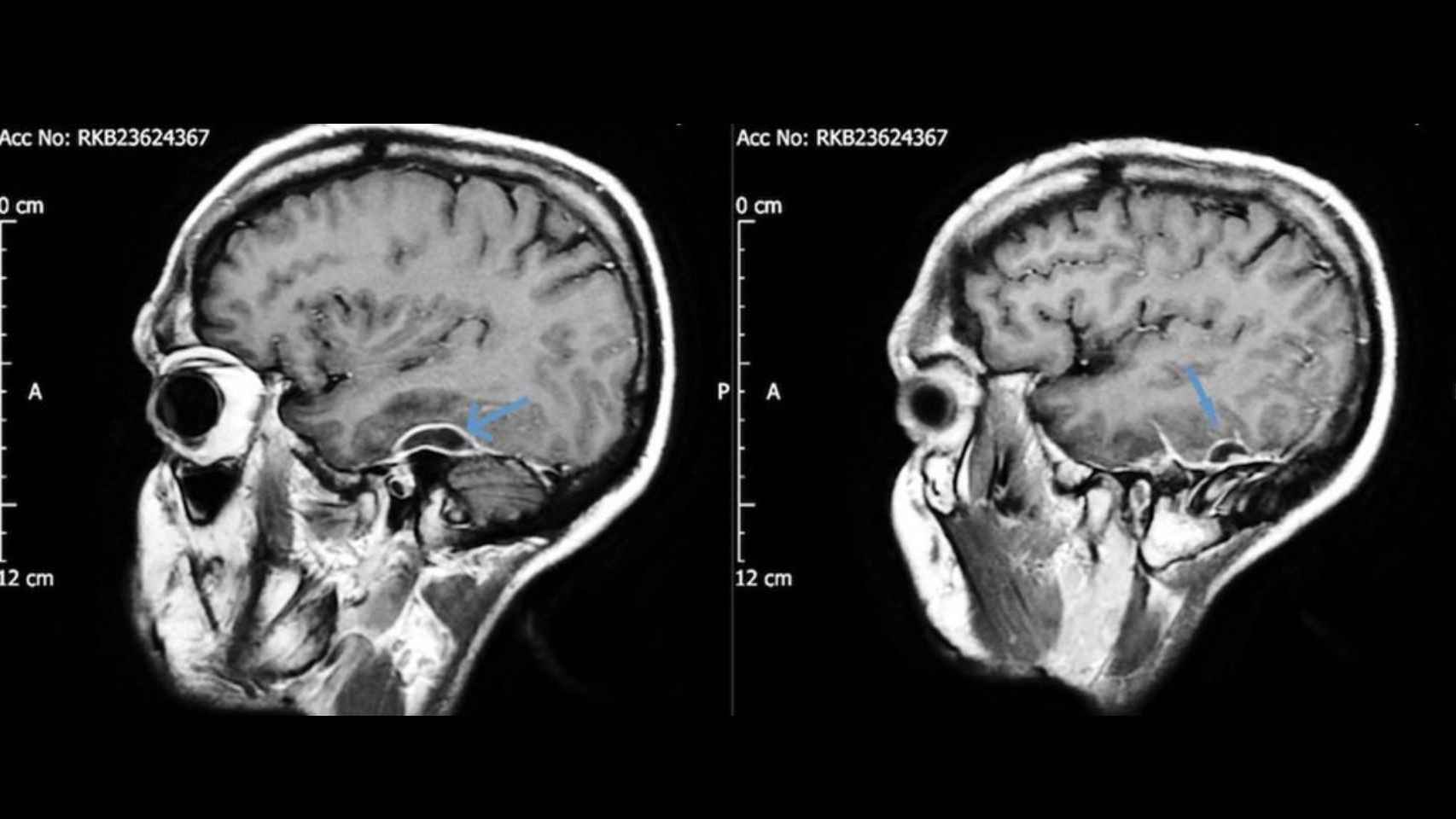 Abcesos de pus en el cerebro del paciente. (Charlton et al, BMJ Case Reports, 2019)
