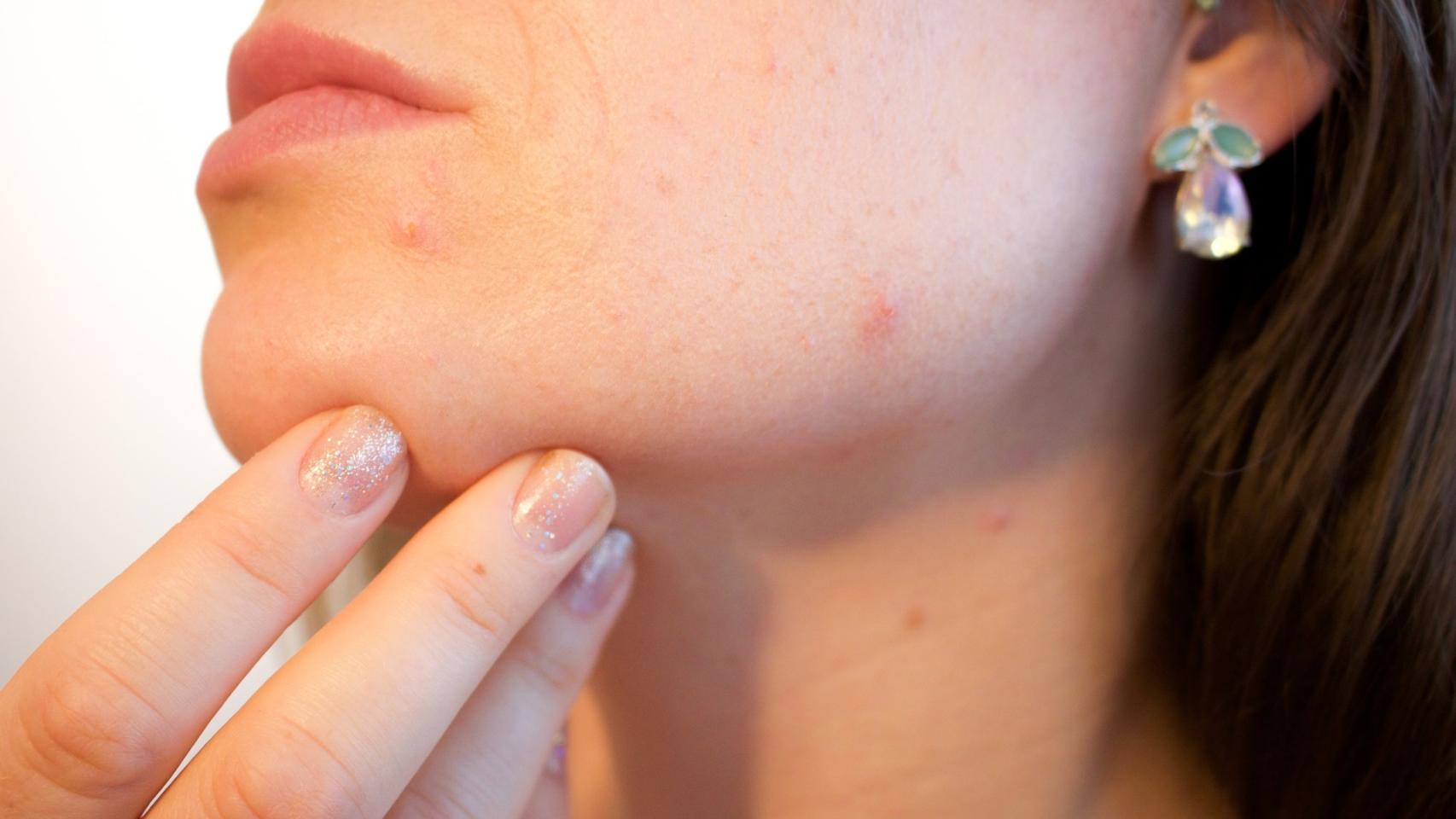 Como eliminar el acné de forma saludable y natural