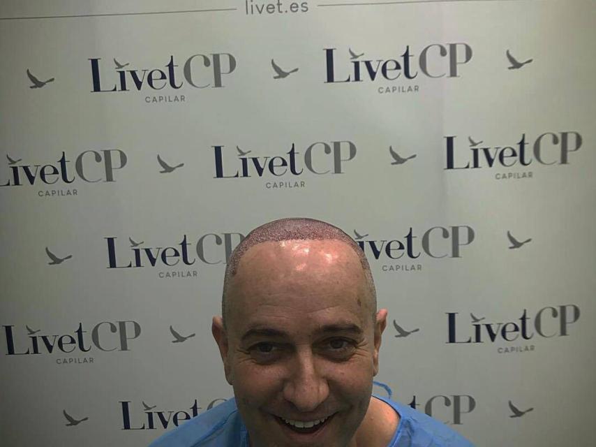Víctor Sandoval minutos después de realizarse un trasplante capilar.