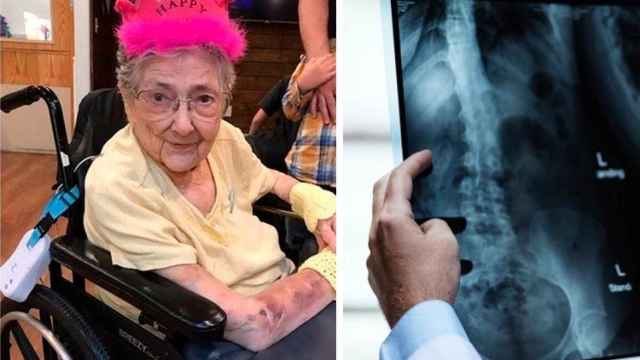 El caso de la mujer que vivió 99 años sin saber que tenía los órganos al revés