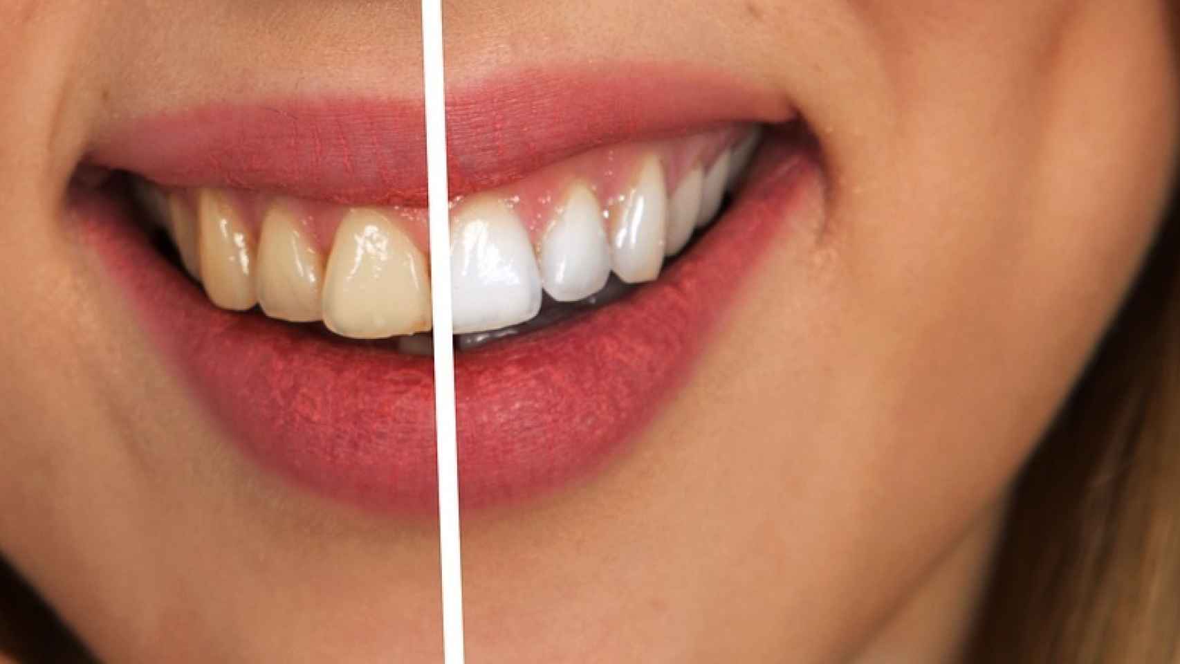 defecto Enseñando Gran roble Cómo blanquear los dientes sin dañar el esmalte