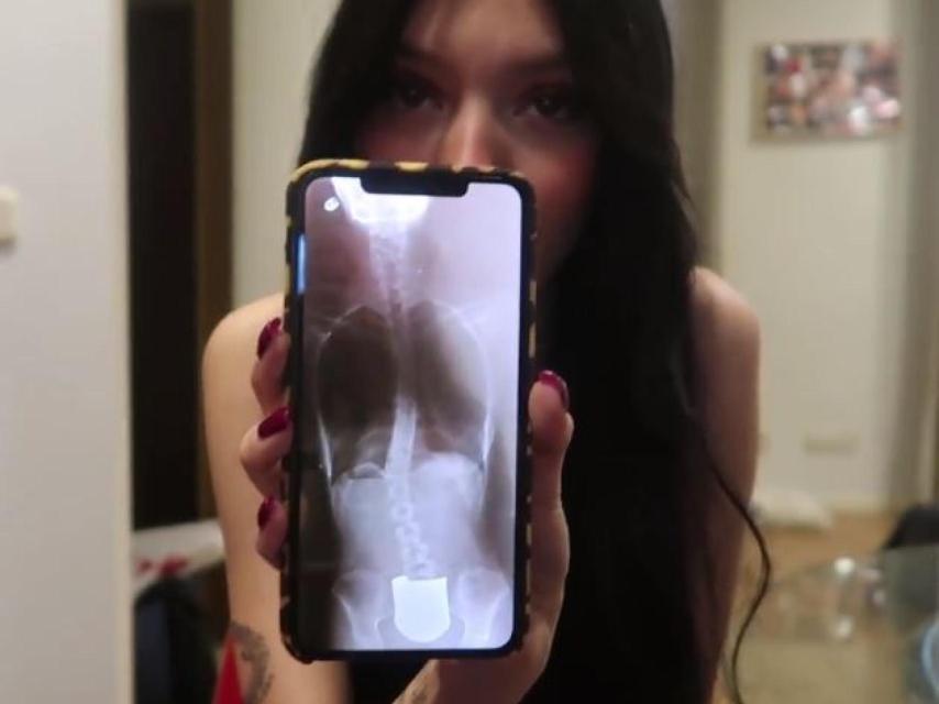 Detalle de la radiografía que se realizó Alejandra Rubio con 15 años.