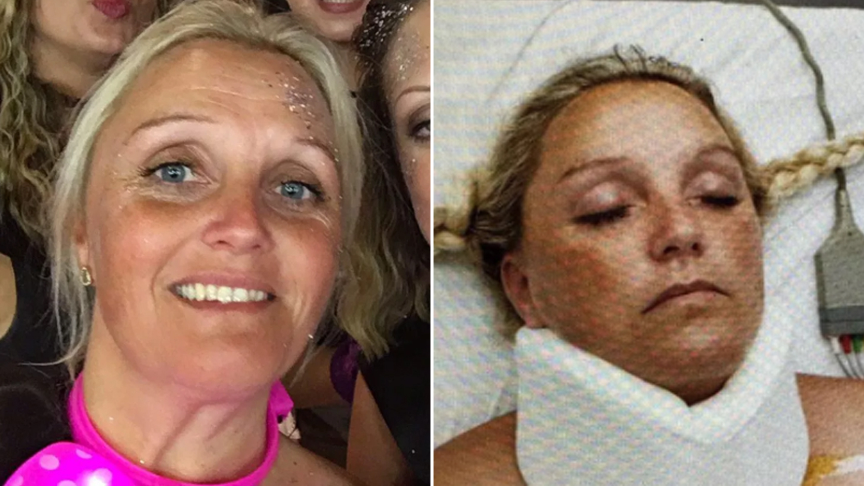 Bonnie antes y después del accidente que sufrió en Magaluf en 2017.