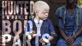 Cazados por partes de su cuerpo, la situación de los albinos en Malawi