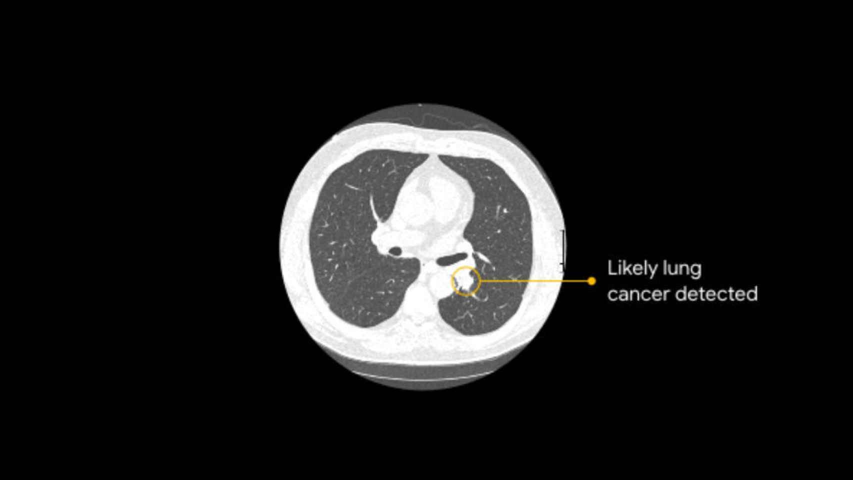 google cancer pulmon 1