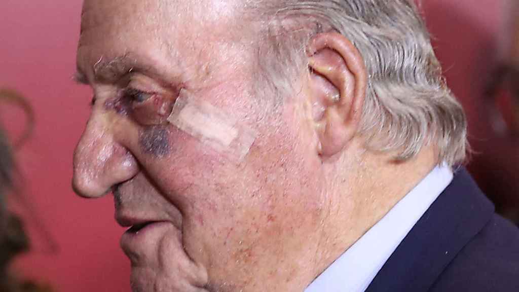 Primer plano del hematoma del ojo del rey Juan Carlos tras la extirpación de un carcinoma basocelular.