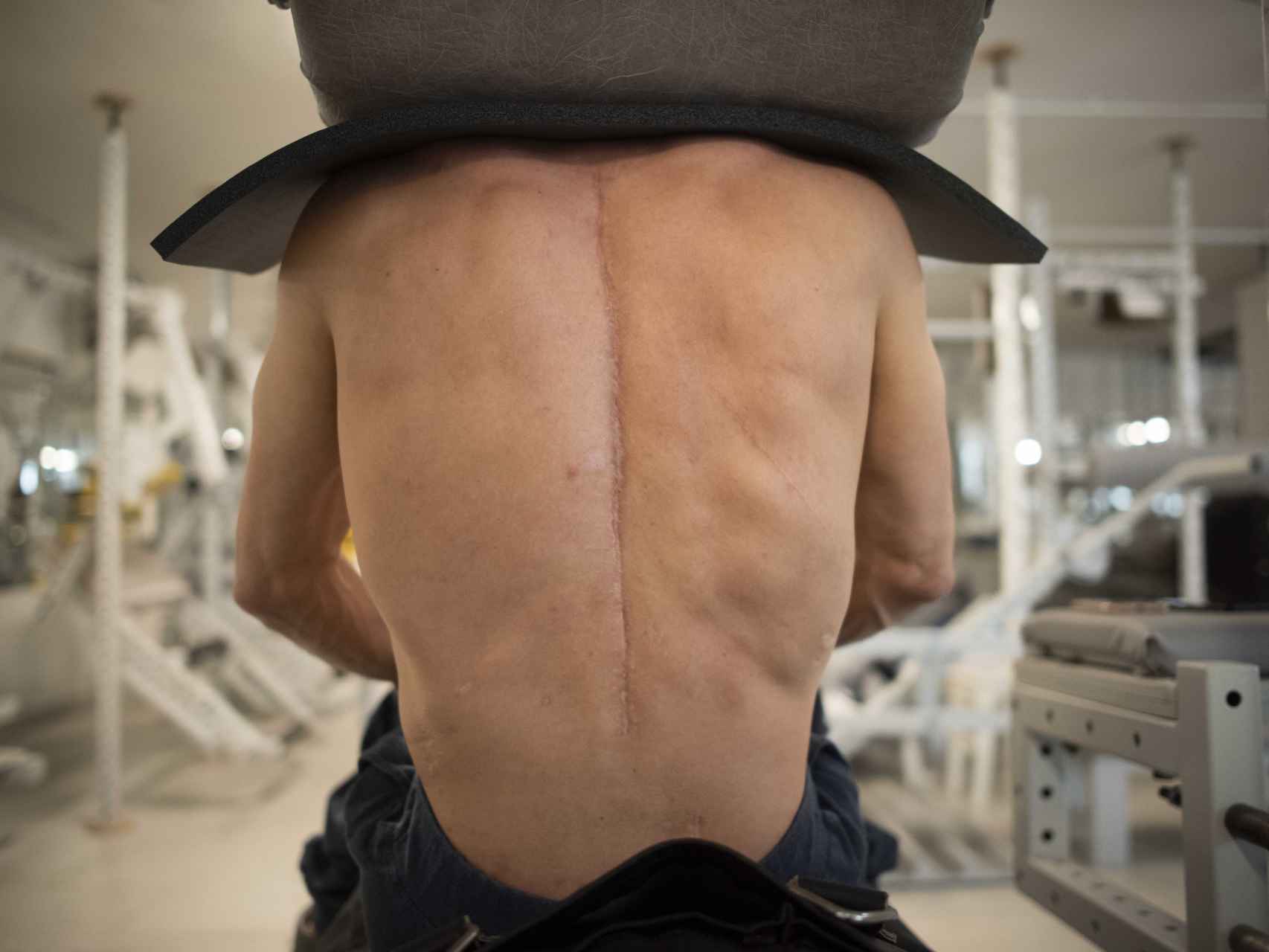 Hace tres años un médico israelí extrajo de la espalda de Sergejus Beglikas la estructura de hierro que sujetaba su columna. La cicatriz que luce es el recuerdo de aquella operación.